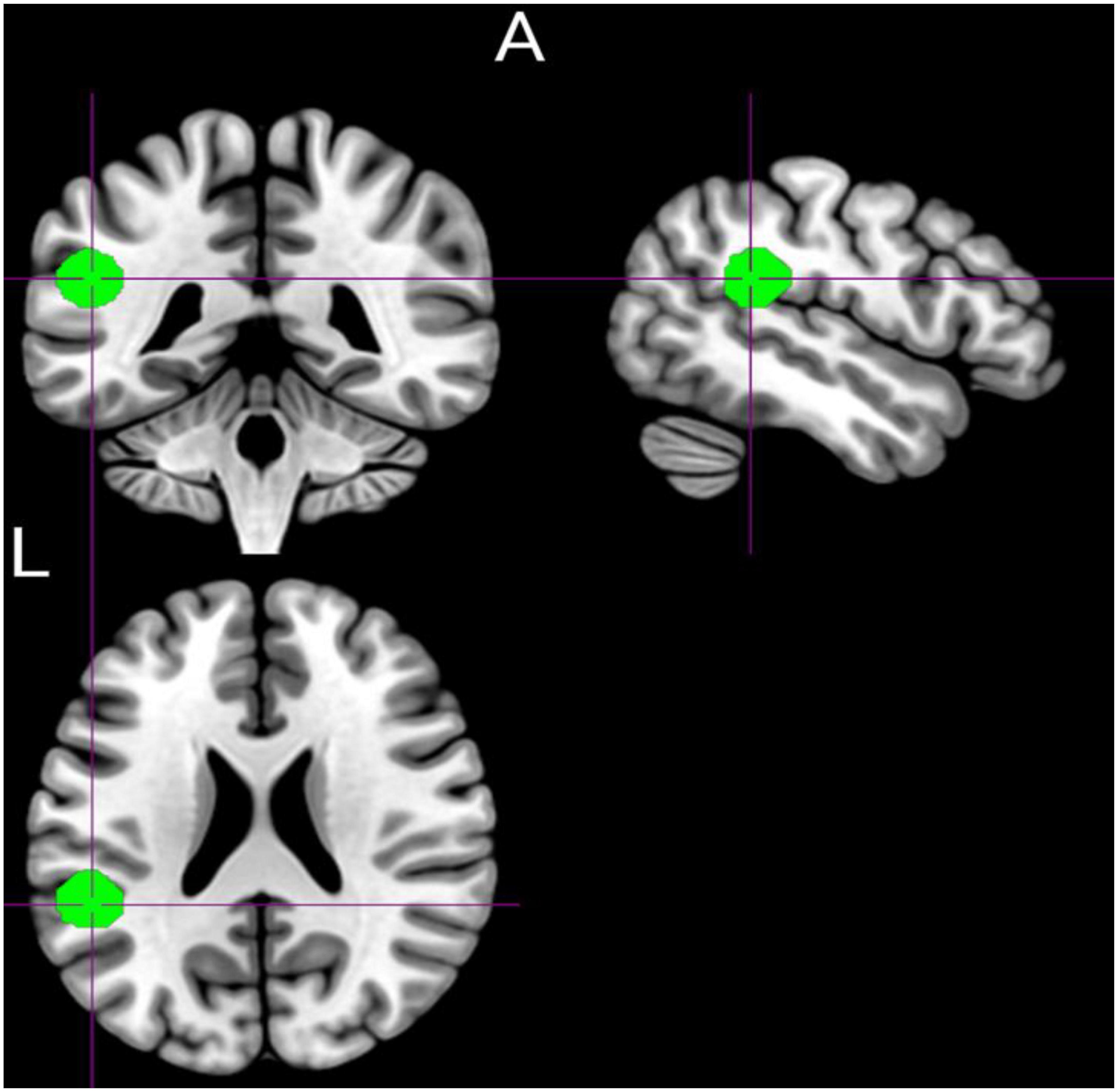 The Static and dynamic functional connectivity characteristics of the left temporoparietal junction region in schizophrenia patients with auditory verbal hallucinations during low-frequency rTMS treatment